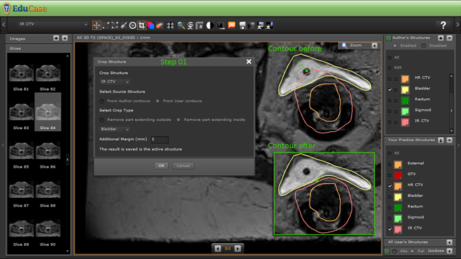 EduCase, Features, Contouring Tools, Cropping Tools for DICOM contours