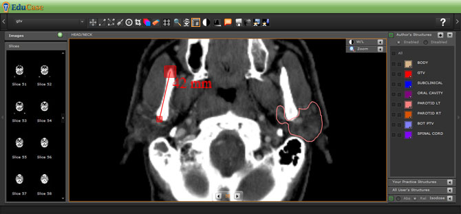 EduCase, Features, Contouring Tools, Measuring Tool for DICOM images