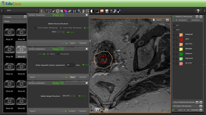 EduCase, Features, Contouring Tools, Expansion Tools for DICOM contours
