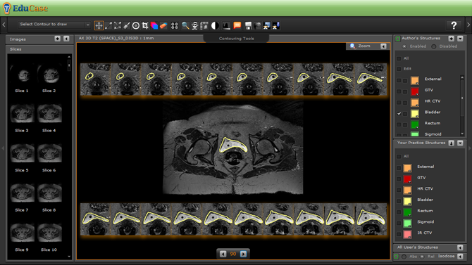 EduCase, Features, Contouring Tools, Interpolation Tools for DICOM contours